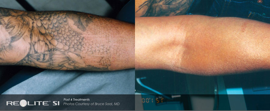 Laser Tattoo Removal Total Body Laser Center Inc