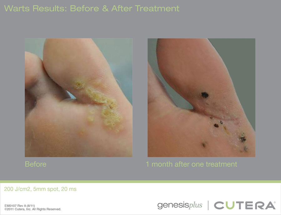 Planter Warts Total Body Laser Center Inc
